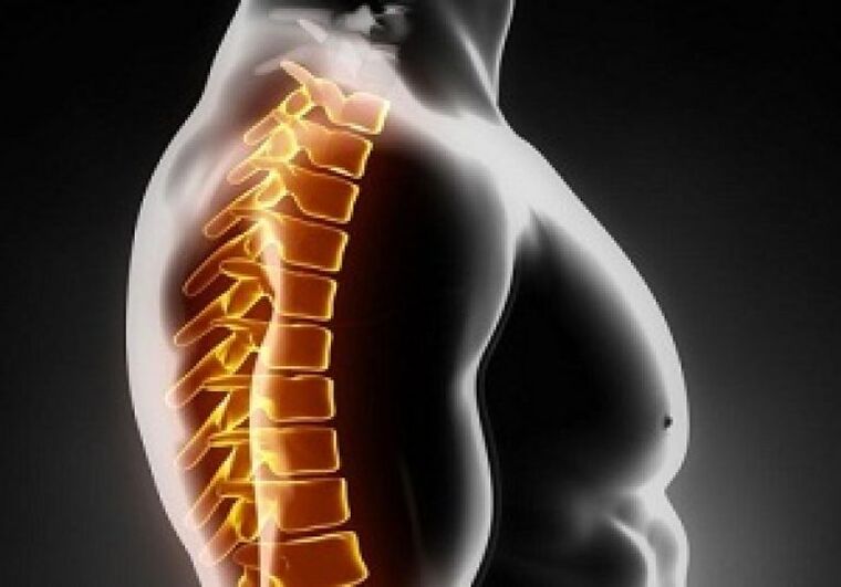 Osteocondroza toracică însoțește durerea și disconfortul la mijlocul spatelui
