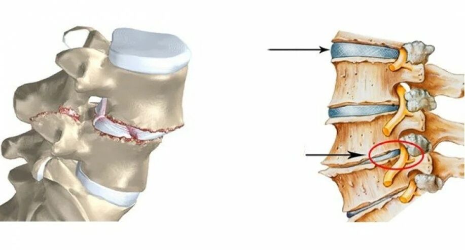 discul vertebral normal și deteriorat